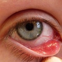 ¿Aconsejable operación para quitar quiste sebáceo en parpado interior del ojo?