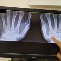 ¿Soluciones trapecio mano rotado (Hipoplasia Pulgar)?
