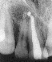 Endodoncia