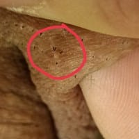 Verruga en zona de comienzo del pene