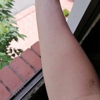 Me salieron unos puntos rojos en la palma de la mano y no se que pueda ser y en los brazos tengo unas manchitas rojas