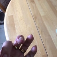 Como tratar descamación y grietas en dedos de manos