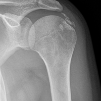 ¿Que me pasa en el hombro izquierdo?