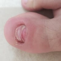 ¿Este es el estado de mi uña, que debo hacer?