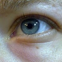 Es normal que te salga esto en el ojo?