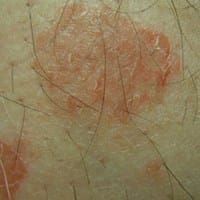 Que es esto un hongo o que?