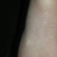 Que son estas manchas blancas dentro de la piel?