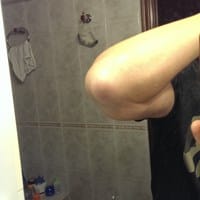 Llevo un mes con bursitis en el codo sin mejoría..
