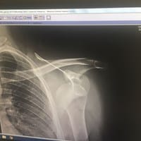 Luxación del Hombro. Qué aconsegáis