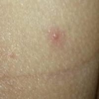 Granito en las nalgas? Color rojo y muy pequeño que duele al caminar