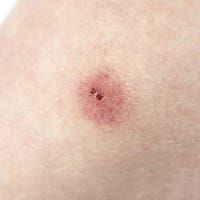 Picaduras en las piernas remedios para las marcas