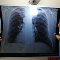 Interpretación radiográfica pulmonar, ¿Podría ser cáncer?