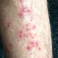 Puede ser que sea una enfermedad los aujeros en los barritos?