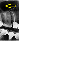 Elemento extraño en radiografía dental