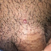 Me ha salido un grano ¿Será malo?