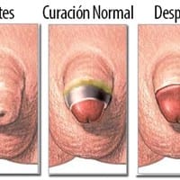 Tengo dudas de una circuncisión de hace 4 días