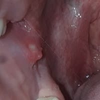 ¿Qué es este bulto que tengo en la mejilla por dentro de la boca?