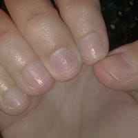 Hola maidprad, hace casi dos meses comenzaron a aparecer pequeños hoyos en ¿Qué les pasa a mis uñas?