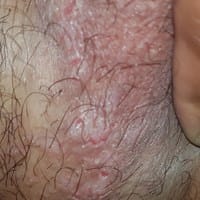 Problema en piel de escroto