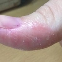 Quemadura en el pulgar con superglue
