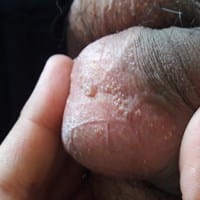 Hace un año tengo unos granitos en mi pene y son granitos indoloros y me aparecieron después de masturbarme son malos?