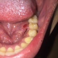 Tengo miedo tenia una roncha en forma de domo medio translucida en el piso de la boca pequeña y ahora esta roja