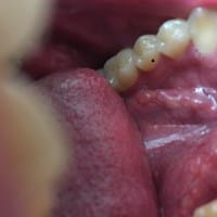 Bolita o ampolla en el suelo de la boca medio transparente