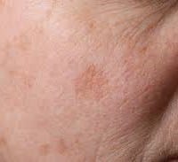 Manchas color café con leche y bultos por todo el cuerpo.