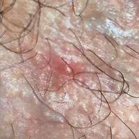 ¿Qué es este bultito en el pene?