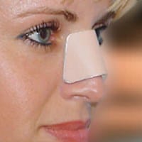 Mi hija se golpeo la nariz