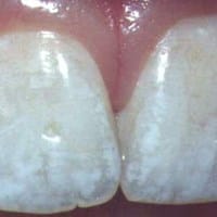 Tengo los dientes con manchas moteadas de blanco