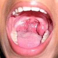 Infección en la garganta o algo más grave?