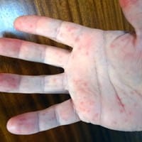 Puntitos rojos aparecen y desaparecen sobre todo en las palmas de las manos