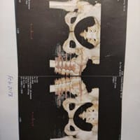 ¿Qué le ocurre a esta persona en la cadera?