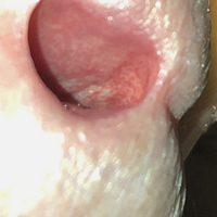 Manchas en la uretra, que es?