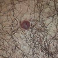 Grano o lunar extraño en mi pecho