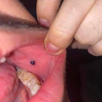 Me salió una bolita o bulto en el interior de la mejilla