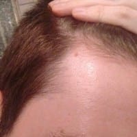¿Falta de pelo en laterales y entradas?