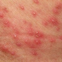 ¿Algo para la irritación de la piel por el depilado?