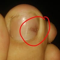 ¿Mancha bajo la uña del pie derecho?