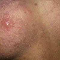 6 bolitas en los testiculos rojas inflamadas con picazon mayormente en la noche
