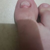 Uña del dedo del pie, necesito asistencia