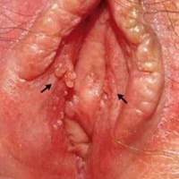 Tengo granos vaginales o algo más
