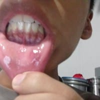 ¿Me duele mucho los dientes y se pueden ver a través de las encías?