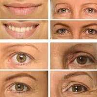 ¿Cuál es mejor tratamiento para eliminar marcas de acné?