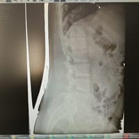 ¿Es bueno el yoga para la lordosis lumbar?